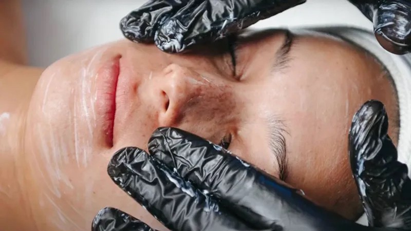 A peel treatment is a smarter alternative