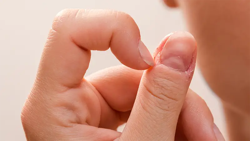 Dry Peeling Cuticles