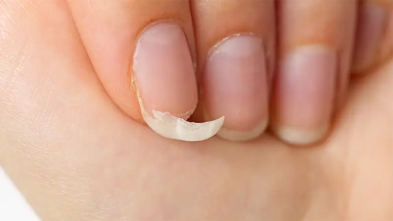 Weak Brittle Nails