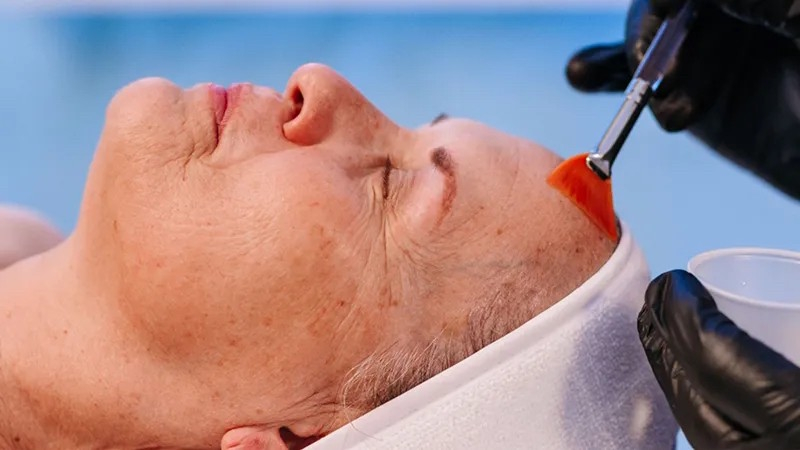 Benefits of peel treatments