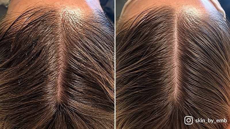 Image of before and after scalp treatment